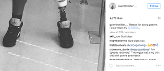 Quentin Miller Feet, Lost Leg, Falco Lombardi